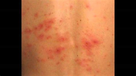 Rashes On Torso Not Itchy Pictures Photos