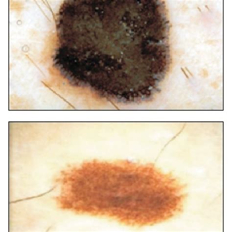 Dermoscopic Images Of Micro Melanoma Lesions Based On 1 Download