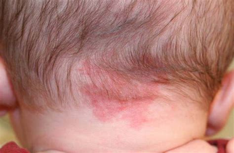 Does Your Baby Has Birthmarks Here Are Some Myths And Facts