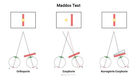 Maddox Rod Test Atlas Der Augenheilkunde