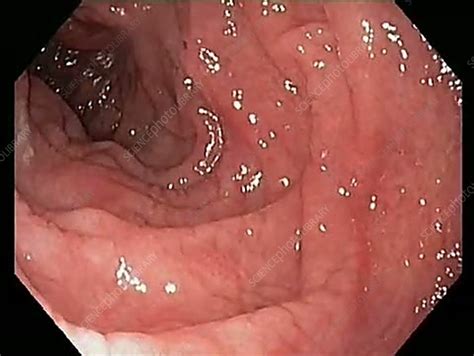 Han y, chen w, li p, ye j. Duodenum in coeliac disease - Stock Video Clip - K002/8822 ...