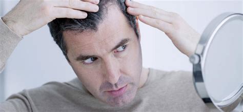 Male Pattern Baldness Causes Symptoms And Treatment Options Justinboey