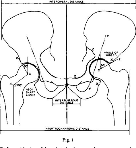 Figure 1 From Bone Grafting For Protrusio Acetabuli During Total Hip