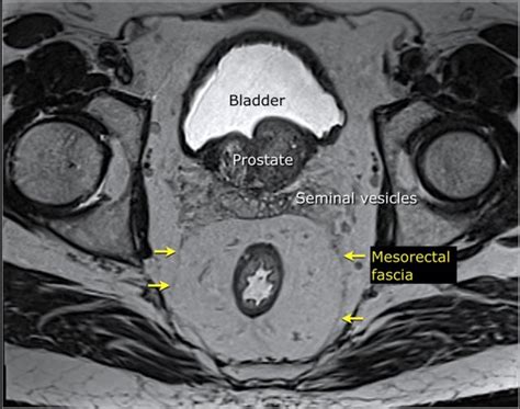 Mri Of Rectal Cancer Tumor Staging Imaging Techniques And Management