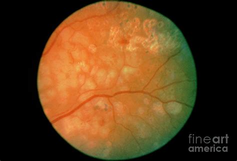 Diabetic Retinopathy Post Argon Laser Treatment Photograph By Western