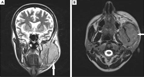 Figure 1 From A Rare Case Of An Extranodal Head And Neck Lymphoma
