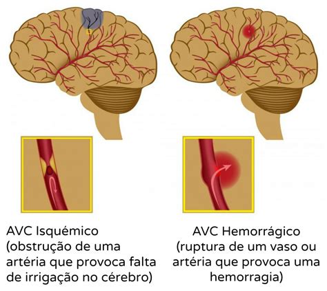 Tipos De AVC NeuroSer