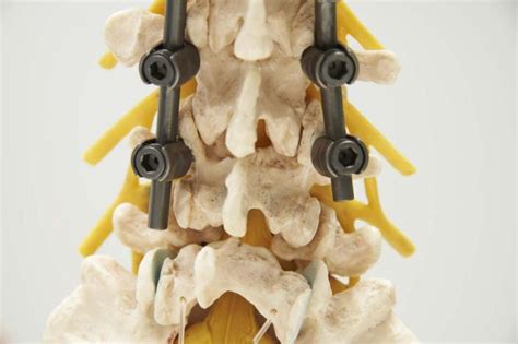 Lumbar Fusion Precision Spine And Orthopedics Inc