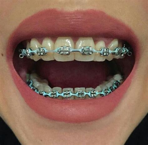 Pin By Cecilia Hernndez On Ortodoncia Braces Colors Cute Braces Cute Braces Colors