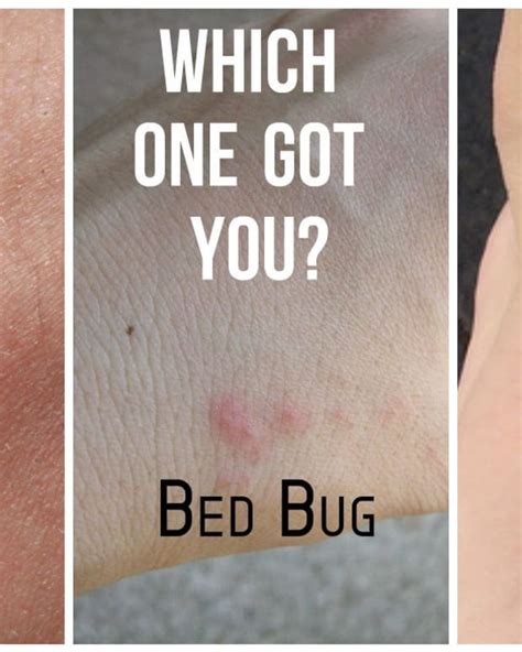 Infected Bed Bug Bites