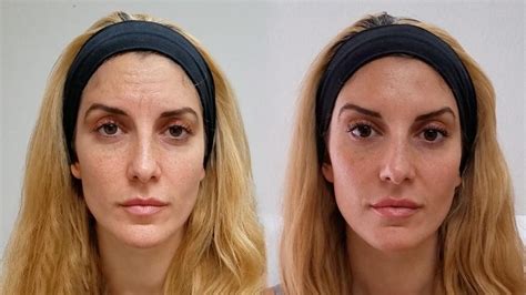 before and after botox fillers chemical peels natural injector — natural injector
