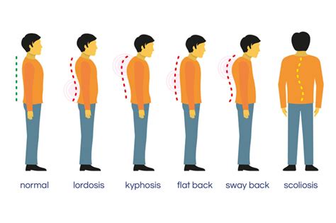 5 Types Of Posture Problems And How To Fix Your Posture Backembrace