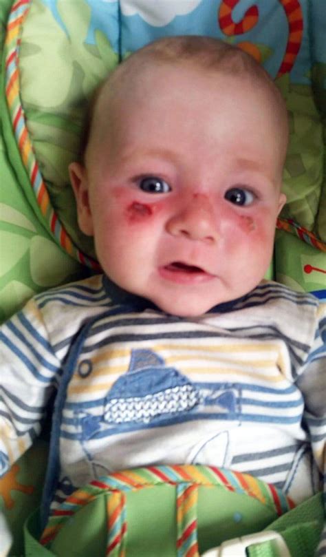 Four Month Old Baby Left With Blisters On His Swollen Face After