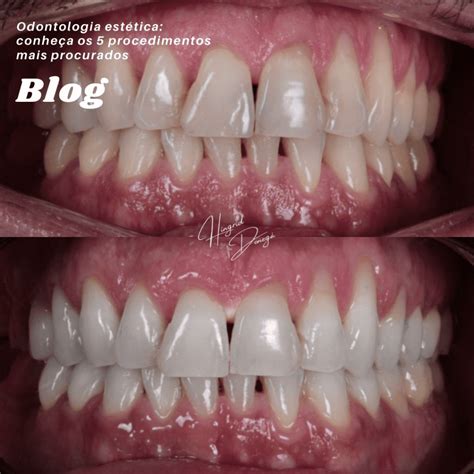 Odontologia Estética Conheça Os 5 Procedimentos Mais Procurados