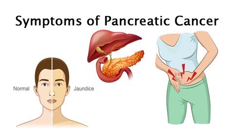 The pancreas is an organ that secretes enzymes that aid digestion by breaking down. 8 Symptoms of Pancreatic Cancer - WomenWorking
