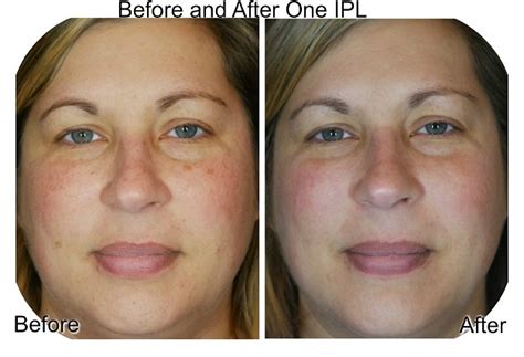 Intense Pulsed Light And Laser Therapy Charmed Medispa