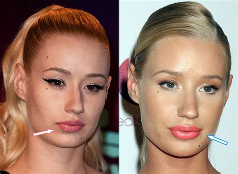 iggy azalea lip injections before and after photo compare in 2021 celebrity plastic surgery