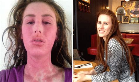 Woman Left With Red Raw Skin Due To Extreme Skin Express