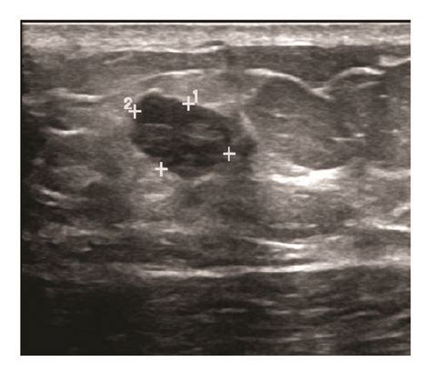Breast Ultrasound Lobulated Solid Left Breast Mass At 1100