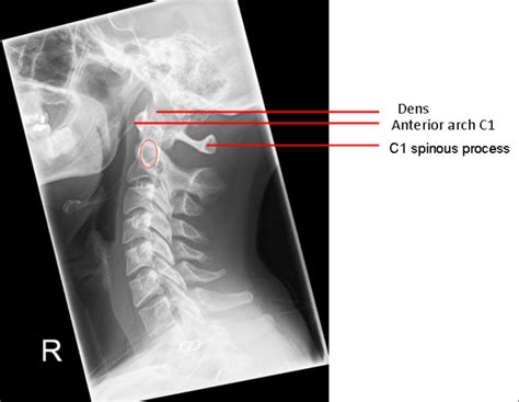 Image 1 Lateral Plain Radiograph Of The Cervical Spine Demonstrating
