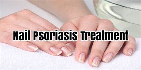 Pin By Diane Manseill On Psoriasis And Exema Nail Psoriasis Treatment