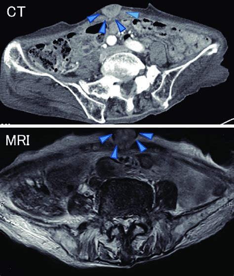 Contrast Enhanced Ct And T2 Weighted Mri Of The Abdomen Showing An