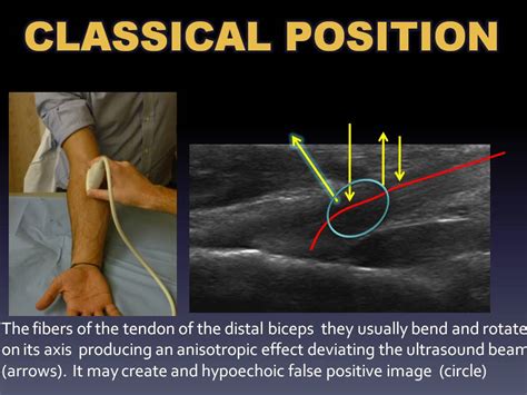 Distal Biceps Rupture Ultrasound