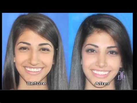 Rhinos, nose + plassein, to shape. Rhinoplastik Nasenkorrektur Expertenerten | Doovi