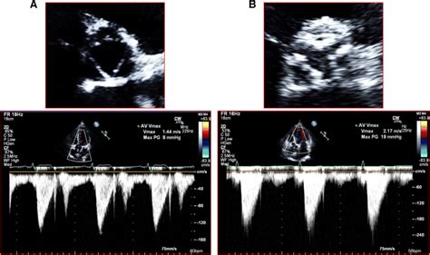 The Transthoracic Echocardiographic Images Of Normal Aortic Valve And