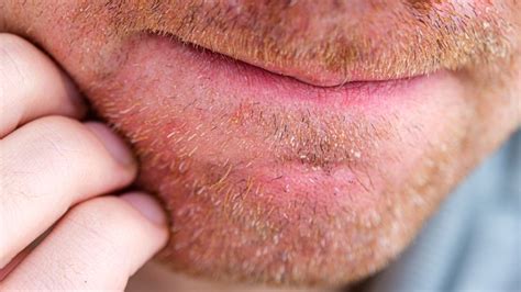 What It Really Means When Your Beard Itches