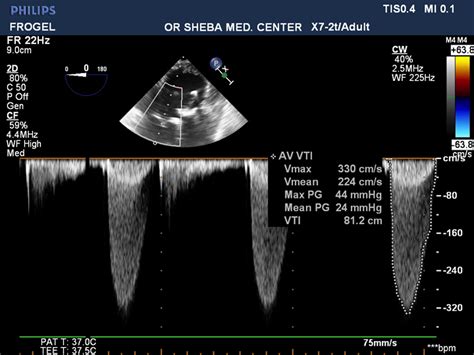 Aortic Valve Prosthesis Patient Mismatch In A Patient Undergoing Redo