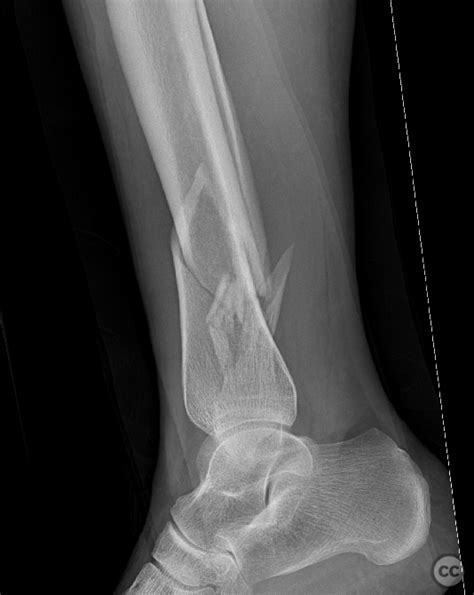 Combined Distal 13 Tibia And Comminuted Fibula Fracture With Sad
