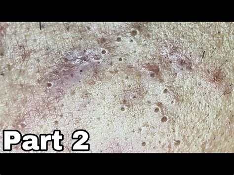 2 Blackheads For Those Who Are Addicted To Watching Them Byoung Spa