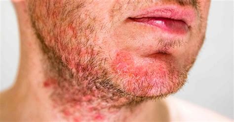 The 5 Types Of Folliculitis Causes And Treatment 2024