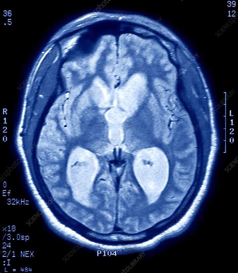 Alzheimers Disease Mri Brain Scan Stock Image C0096589 Science