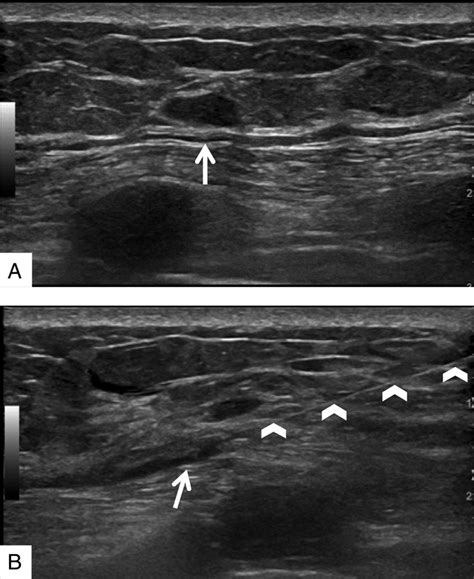 Ultrasound‐guided Breast Biopsies Bhatt Journal Of Ultrasound In