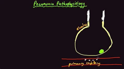 Pathophysiology Of Pneumonia Youtube