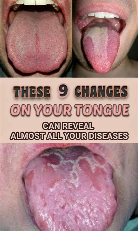 Be Aware Of This These Changes On Your Tongue Reveal Almost All Your
