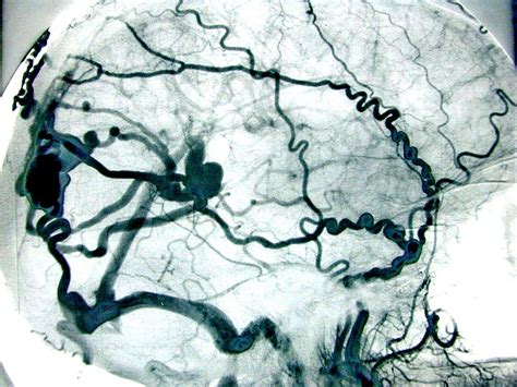 Cerebral Angiography Procedure What Does It Involve