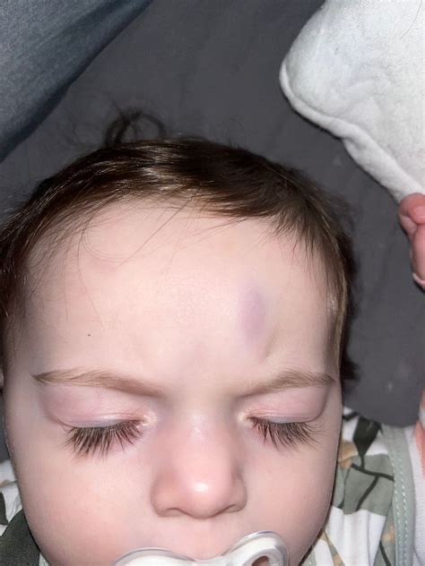 Baby Bumped Head On Coffee Table Babycenter