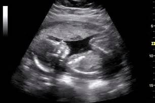 Caring for a baby with a wet or dry cough? How to Read an Ultrasound: Gender and And Abnormality ...