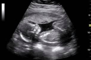 Government employees are generally not protected by this law, however civil service rules offer some protection. Ultrasound detection of congenital CMV infection ...