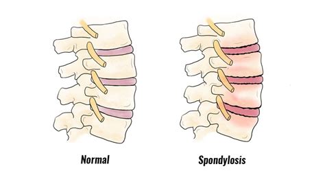 Lumbar Spondylosis Symptoms
