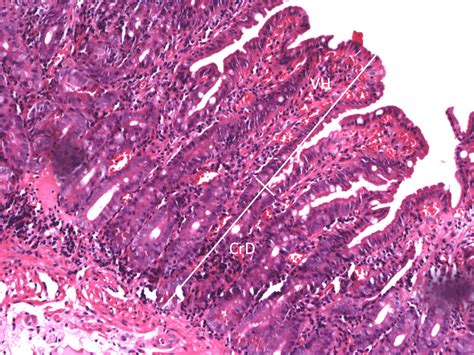 Hematoxylin Eosin Stained Distal Duodenal Mucosa From A H