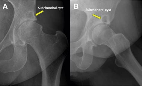 Surgical Treatment Of Subchondral Bone Cysts Of The Acetabulum With