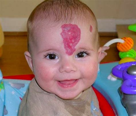 What Are Baby Birthmarks Types Causes And Treatment B