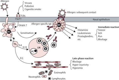 Allergic Rhinitis The Lancet