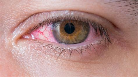 Herpes Am Auge Ansteckung Symptome Und Behandlung