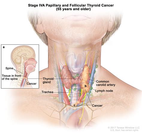 Treatment for prostate cancer usually involves one of three strategies based on the aggressiveness of the cancer and how far the cancer has spread Thyroid Cancer Treatment (PDQ®)—Patient Version - National ...
