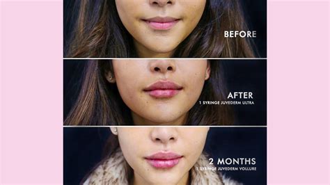Restylane Vs Juvederm For Lips Whats The Difference
